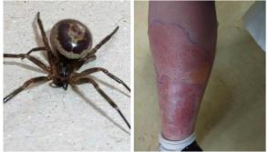 Warning after woman is hospitalised for a week after False Widow spider bite 