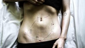 Endometriosis explainer:  A debilitating condition often dismissed