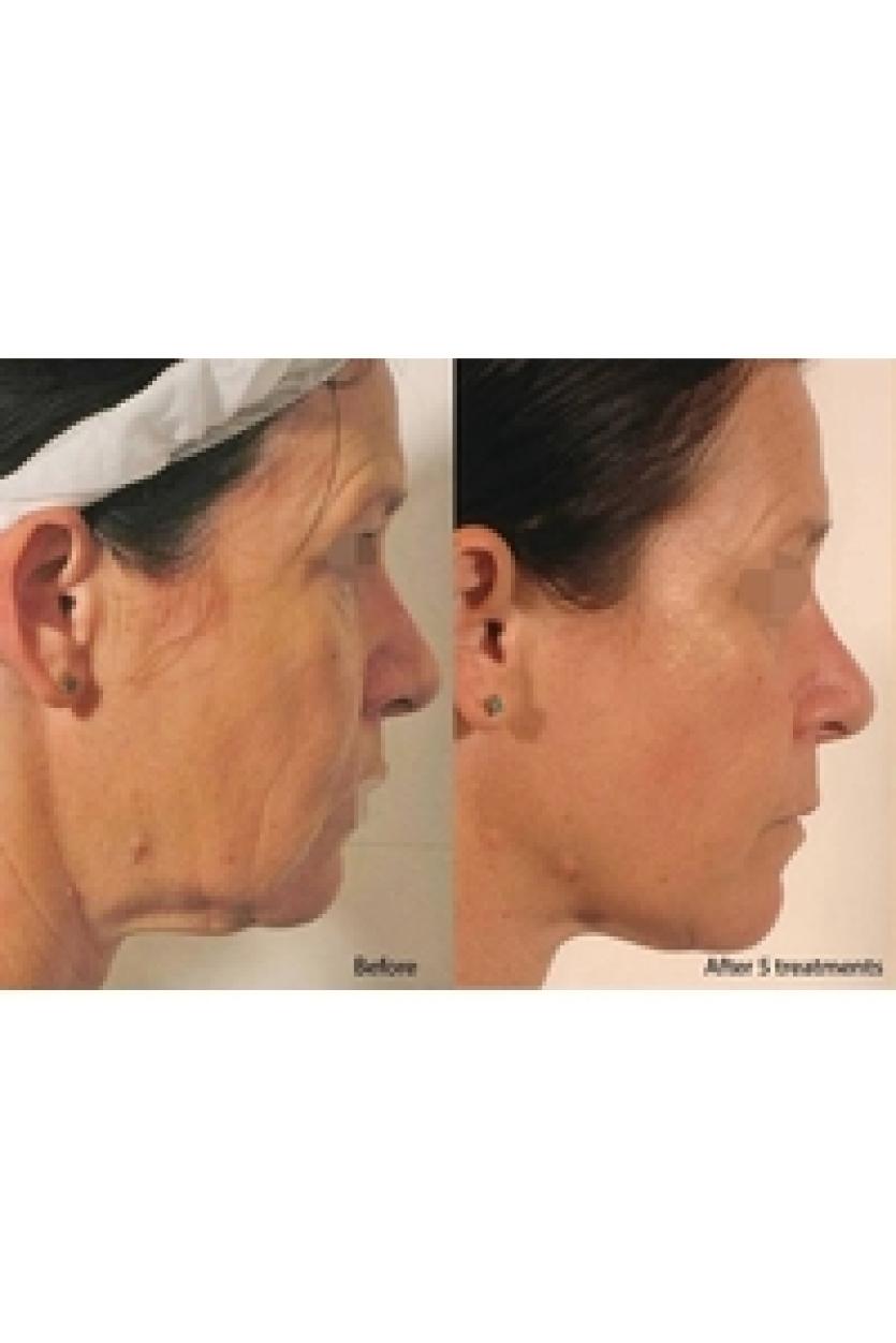 before---after-images-face RESIZED